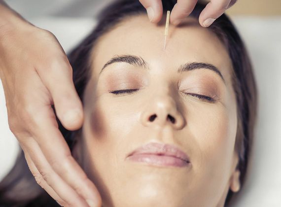 A therapist performs acupuncture on a woman lying with her eyes closed.